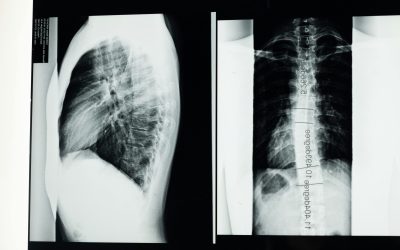 Can an X-Ray Show a Herniated Disc?