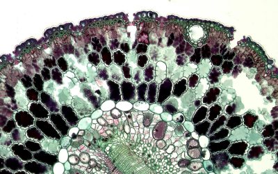 Stem Cell Therapy for Spinal Stenosis: A New Path to Relief