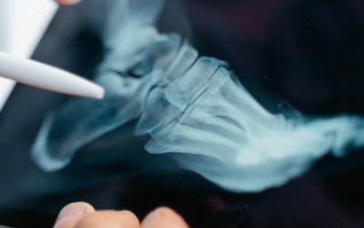 Can You See Arthritis in an X-Ray?