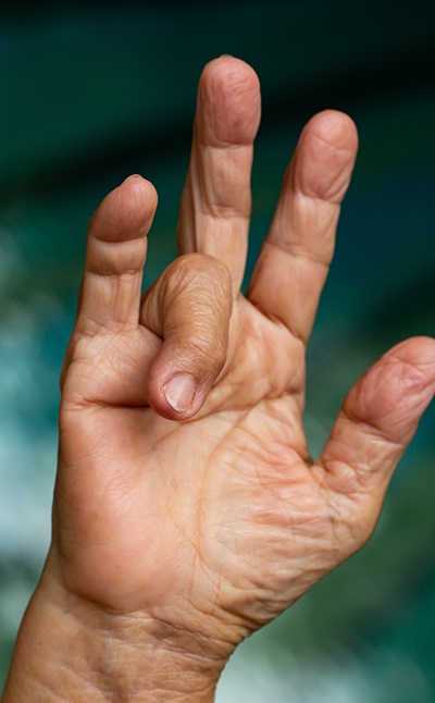 Trigger Fingers Treatments