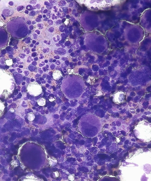 Bone Marrow Aspirate