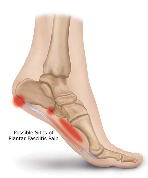 Plantar Fasciitis