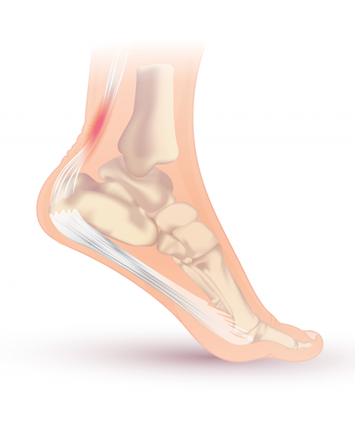 Plantar Fasciitis Treatments